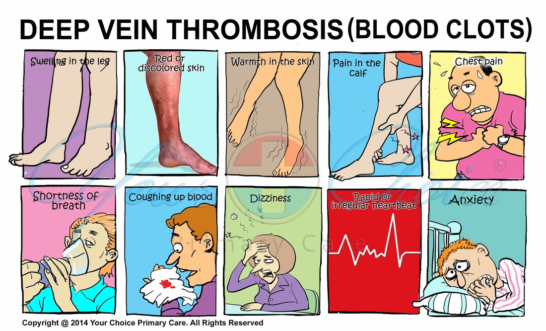 Deep Vein Thrombosis: Symptoms, Causes & Treatment
